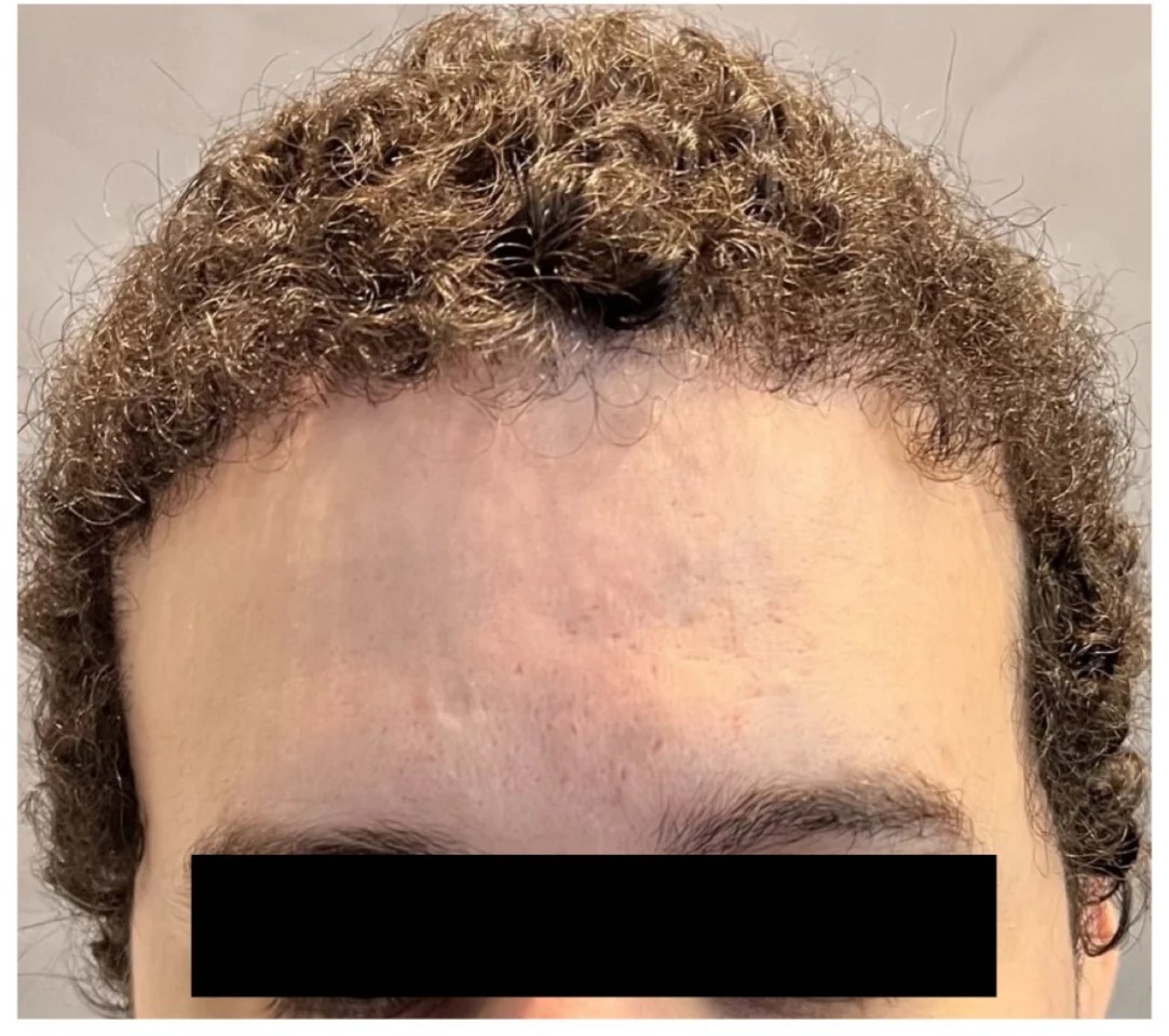 Caso real de transplante capilar: antes com recuo da linha frontal e depois com cachos preenchendo a região frontal, paciente com tarja preta sobre os olhos — depois