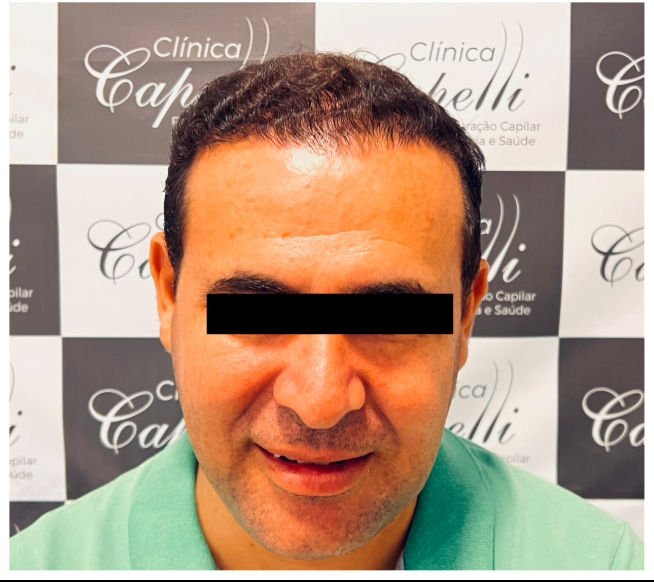 Caso real de transplante capilar: paciente de frente, com tarja preta sobre os olhos, antes com linha frontal desenhada a caneta e rarefação visível, depois com a região frontal preenchida — depois