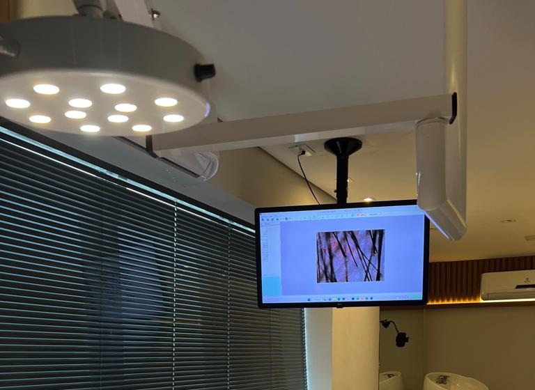Monitor da sala de procedimento exibindo a tricoscopia digital com couro cabeludo ampliado, ao lado do foco cirúrgico