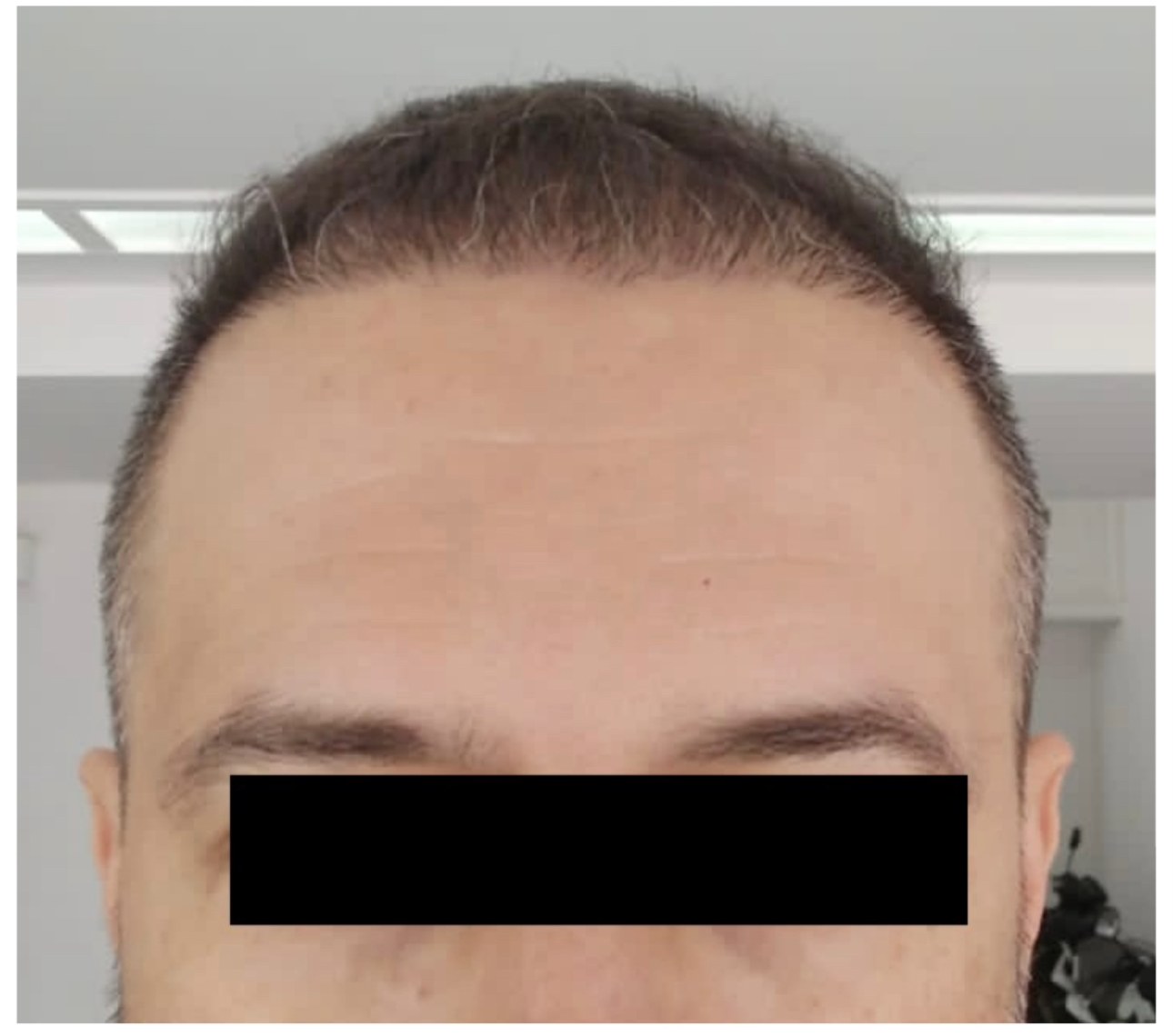 Caso real de transplante capilar: paciente de frente, com tarja preta sobre os olhos, antes com rarefação frontal e depois com a região preenchida — depois