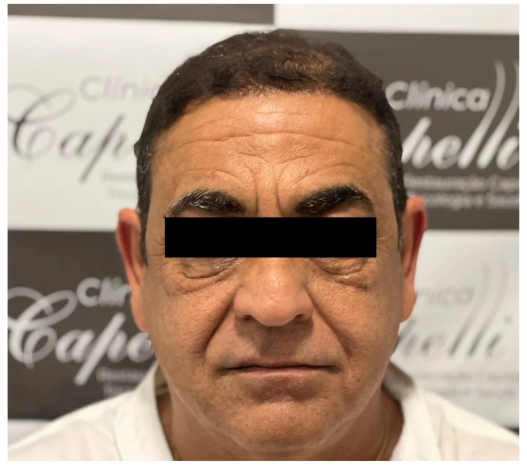 Caso real de transplante capilar: antes com área frontal marcada durante o procedimento e depois com densidade recuperada, paciente com tarja preta sobre os olhos — depois