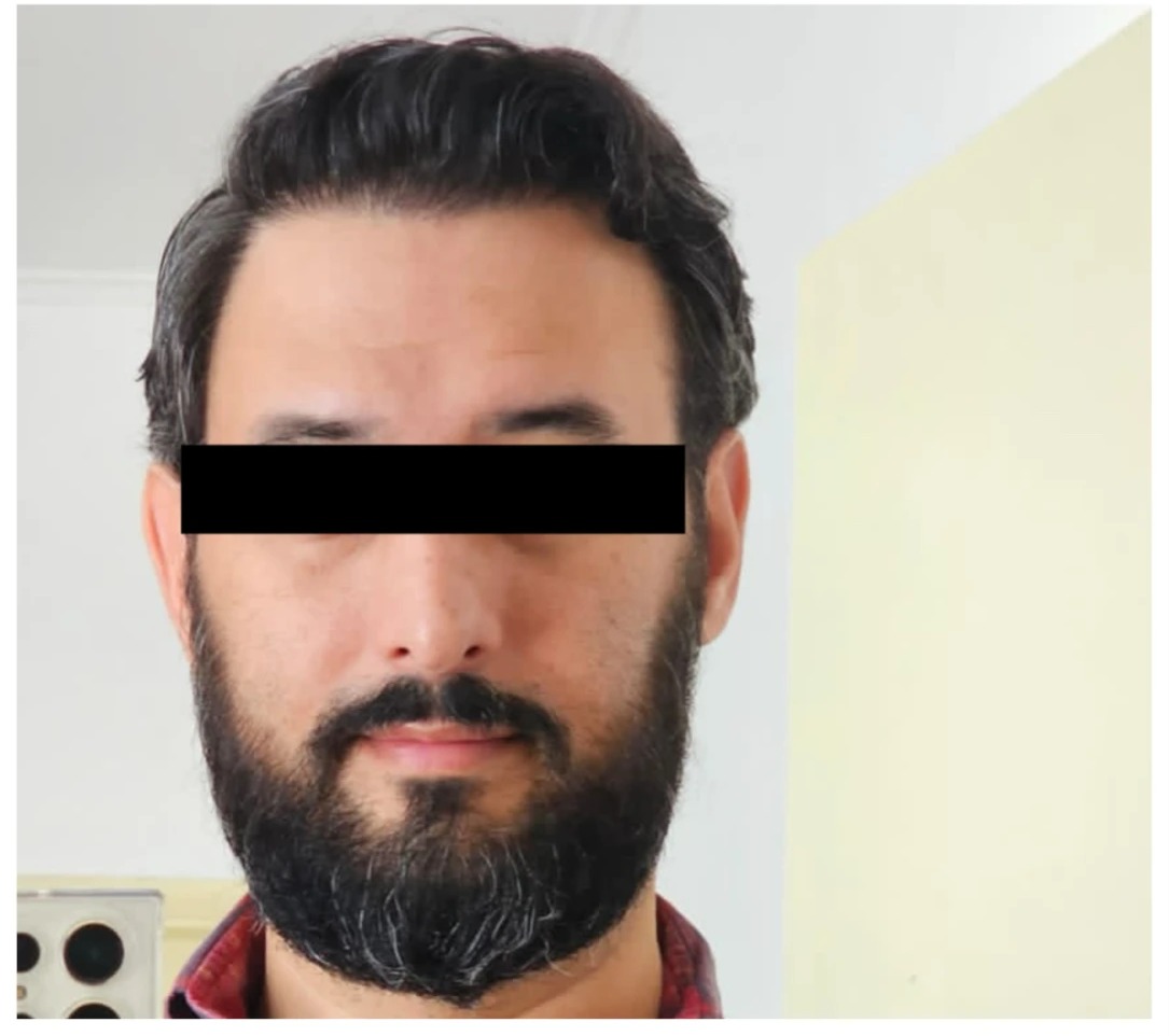 Caso real de transplante capilar: antes com desenho cirúrgico da linha frontal e depois com o cabelo preenchido, paciente com tarja preta sobre os olhos — depois